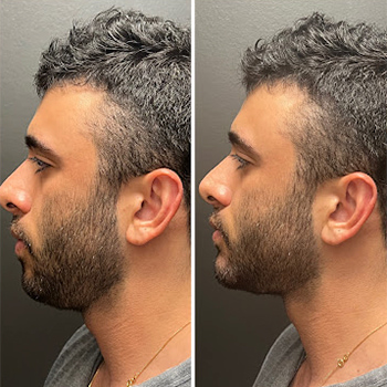 Filler before and after photo