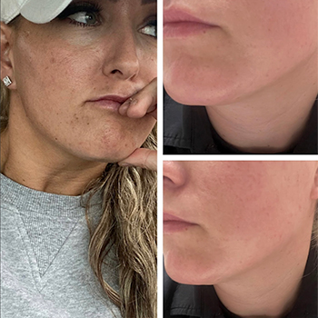 Chemical Peel before and after photo