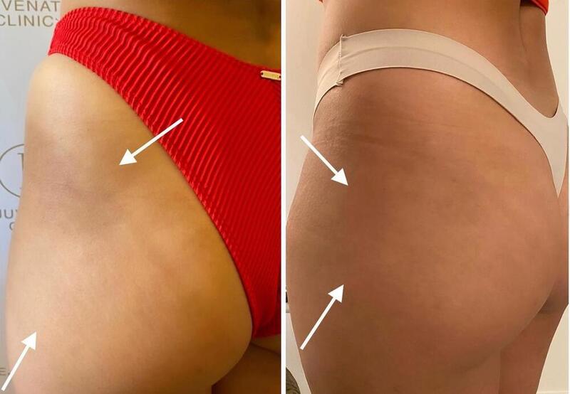 4 Reasons to Get A Radiesse Butt Lift