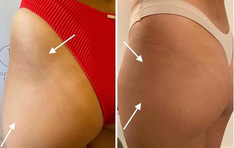 Buttocks Enhancement- Rejuvenation Clinic - Vienna Med Spa