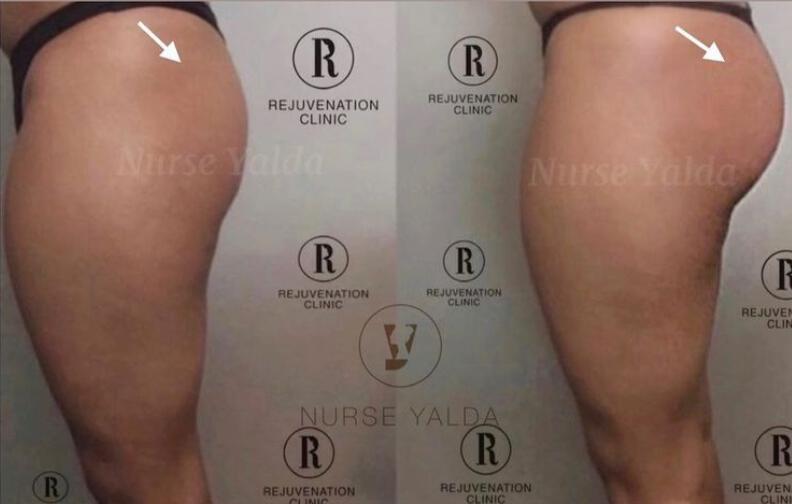 Buttocks Enhancement- Rejuvenation Clinic - Vienna Med Spa