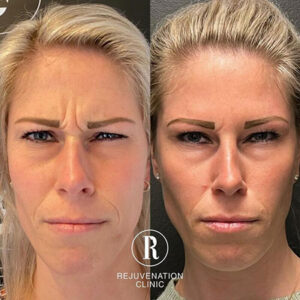Botox Before and After - Rejuvenation Clinic - Vienna Med Spa