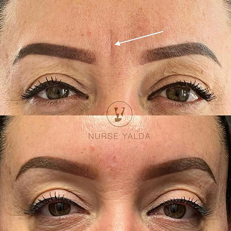 Botox Before and After - Rejuvenation Clinic - Vienna Med Spa