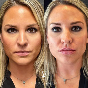 Lip Fillers - Rejuvenation Clinic - Vienna Med Spa