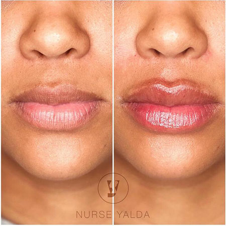 Lip Fillers - Rejuvenation Clinic - Vienna Med Spa