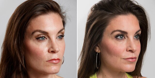 Injectables Fillers - Rejuvenation Clinic - Vienna Med Spa