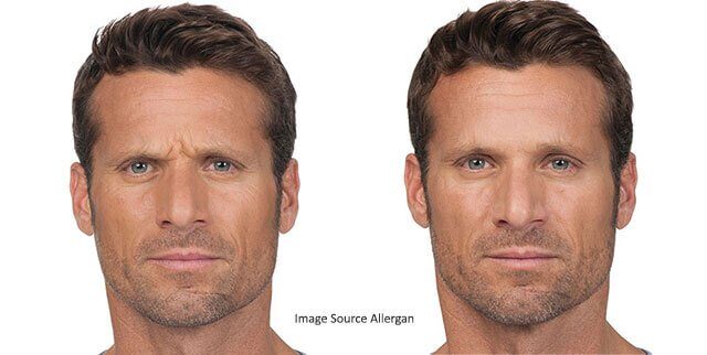 Injectables Fillers - Rejuvenation Clinic - Vienna Med Spa