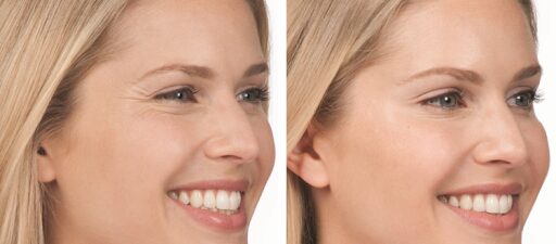 Botox Cosmetic - Rejuvenation Clinic - Vienna Med Spa