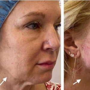 Dermal Fillers - Rejuvenation Clinic - Vienna Med Spa