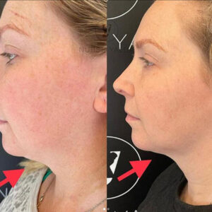 Kybella - Rejuvenation Clinic - Vienna Med Spa