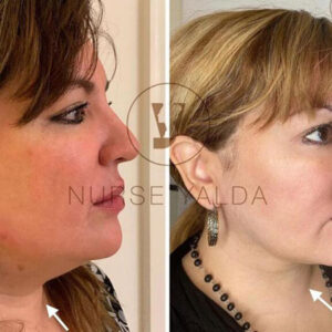 Kybella - Rejuvenation Clinic - Vienna Med Spa