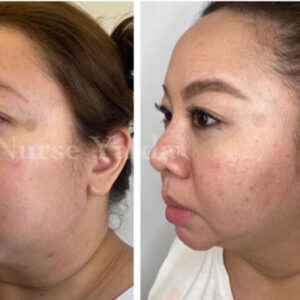 Kybella - Rejuvenation Clinic - Vienna Med Spa