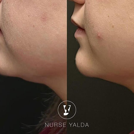 Kybella - Rejuvenation Clinic - Vienna Med Spa