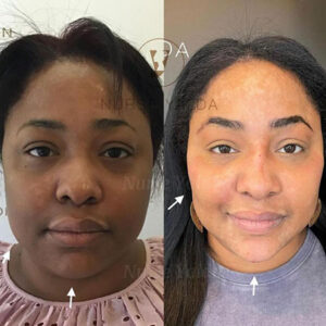 Kybella - Rejuvenation Clinic - Vienna Med Spa
