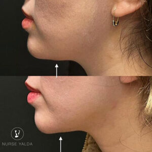 Kybella - Rejuvenation Clinic - Vienna Med Spa