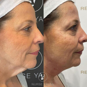 PDO Thread Lift - Rejuvenation Clinic - Vienna Med Spa