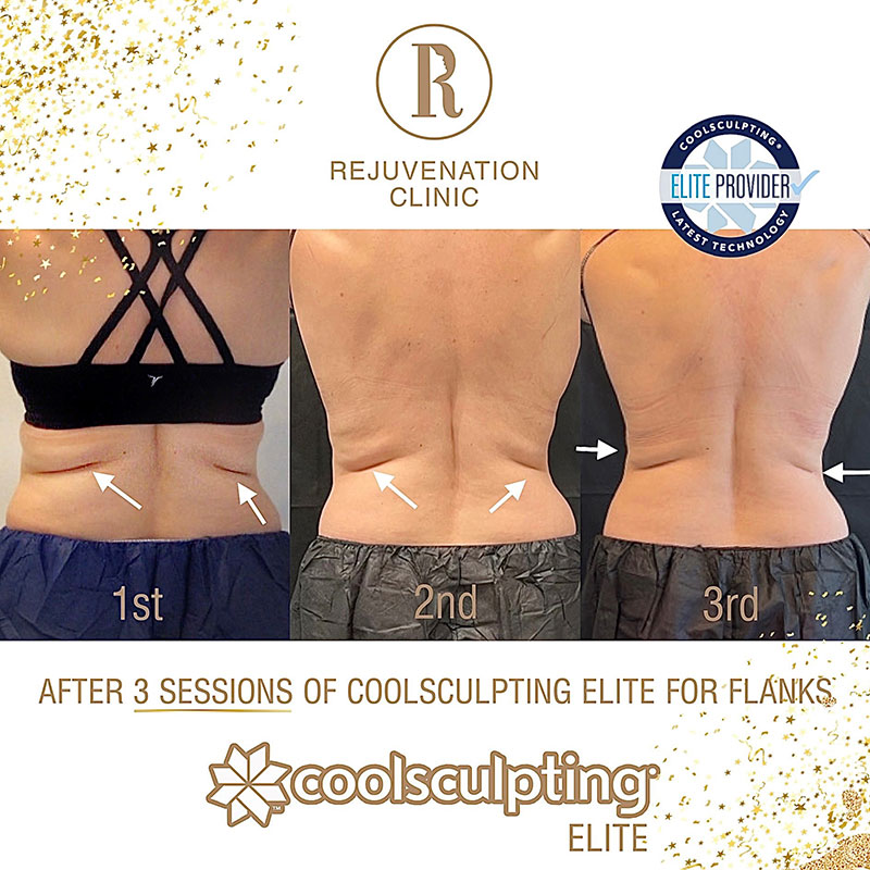 CoolSculpting