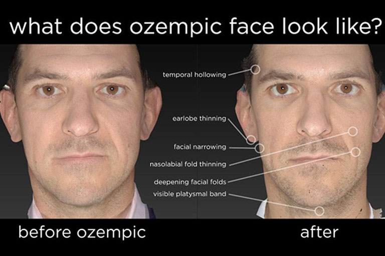 Rejuvenating After Ozempic: The Best Treatments for Ozempic Face