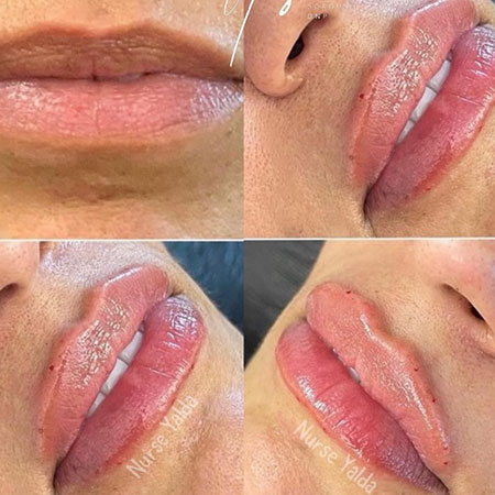 Lip Fillers - Gallery Rejuvenation Clinic - Vienna Med Spa