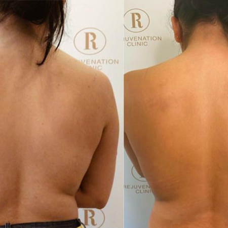 CoolSculpting Before and After - Rejuvenation Clinic - Vienna Med Spa