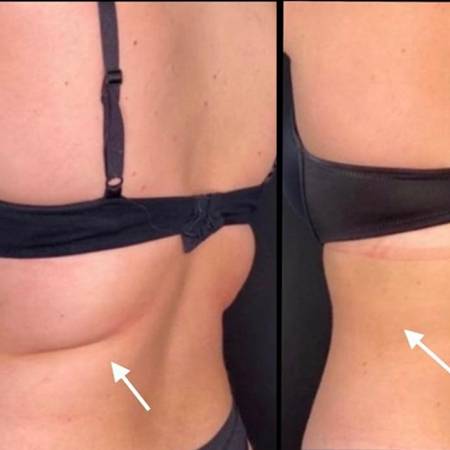 CoolSculpting Before and After - Rejuvenation Clinic - Vienna Med Spa