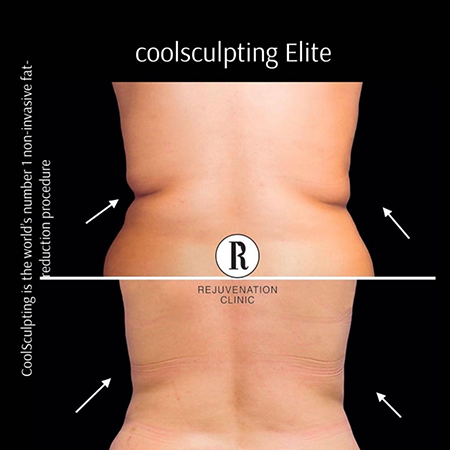 CoolSculpting Before and After - Rejuvenation Clinic - Vienna Med Spa