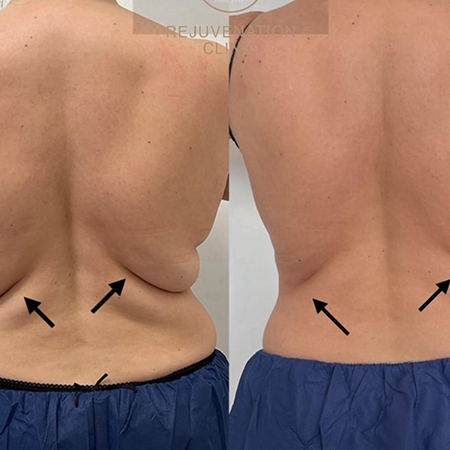 CoolSculpting Before and After - Rejuvenation Clinic - Vienna Med Spa