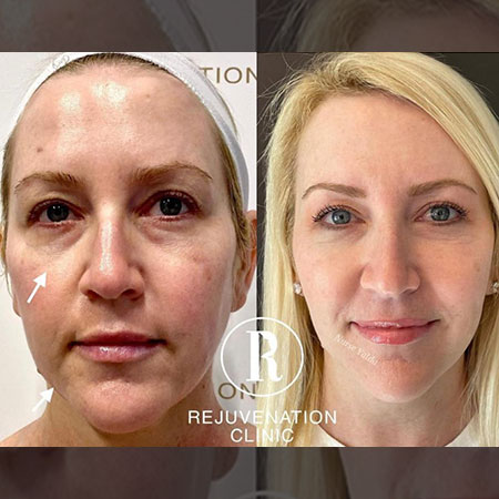 Morpheus8 Face - Gallery Rejuvenation Clinic - Vienna Med Spa