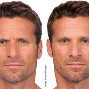 Botox For Man - Before and After - Rejuvenation Clinic - Vienna Med Spa