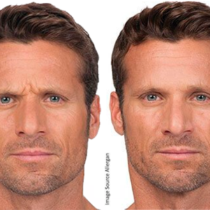 Botox for Men - Rejuvenation Clinic Vienna