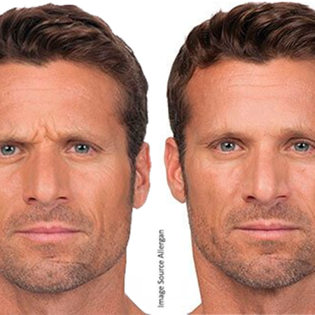 Botox for Men - Rejuvenation Clinic Vienna