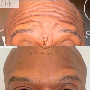 Botox For Man - Before and After - Rejuvenation Clinic - Vienna Med Spa