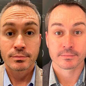 Botox For Man - Before and After - Rejuvenation Clinic - Vienna Med Spa