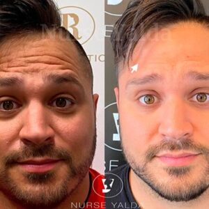 Botox For Man - Before and After - Rejuvenation Clinic - Vienna Med Spa