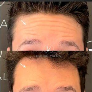 Botox For Man - Before and After - Rejuvenation Clinic - Vienna Med Spa