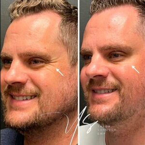 Botox For Man - Before and After - Rejuvenation Clinic - Vienna Med Spa
