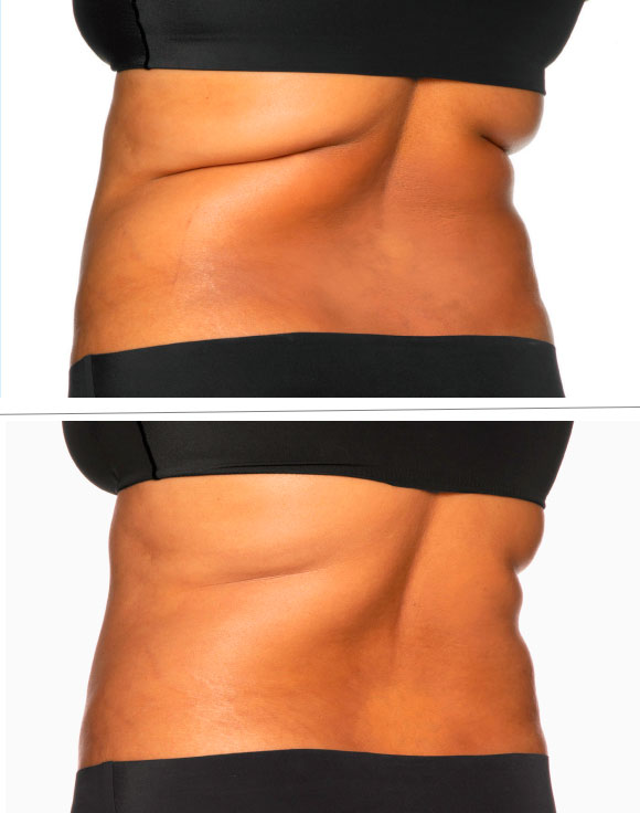 Coolsculpting- Rejuvenation Clinic - Vienna Med Spa