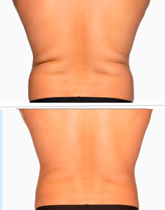 Coolsculpting- Rejuvenation Clinic - Vienna Med Spa