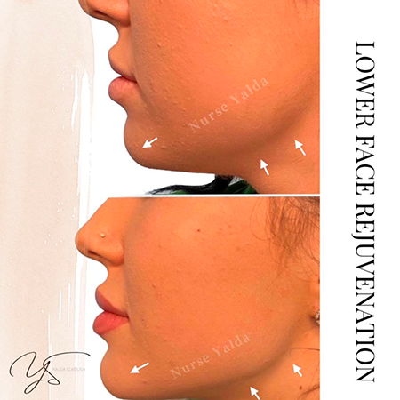 Dermal Fillers- Rejuvenation Clinic - Vienna Med Spa