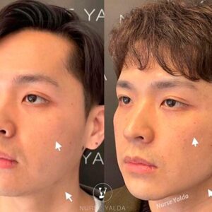 Dermal Fillers - Rejuvenation Clinic - Vienna Med Spa