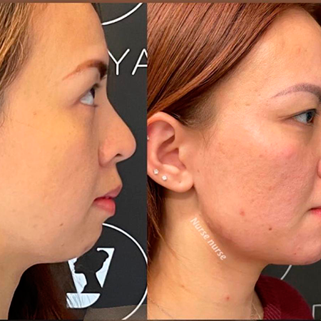 Dermal Fillers- Rejuvenation Clinic - Vienna Med Spa