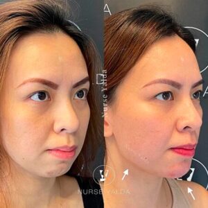 Dermal Fillers - Rejuvenation Clinic - Vienna Med Spa