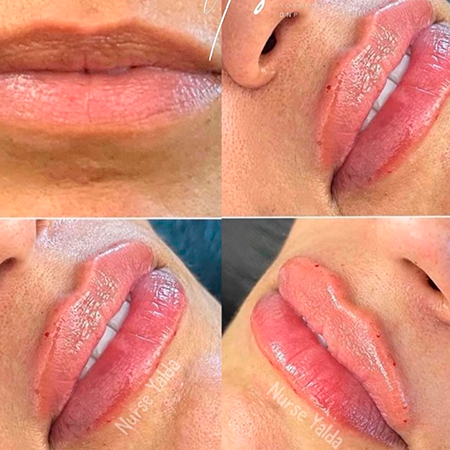 Lip Filler- Rejuvenation Clinic - Vienna Med Spa