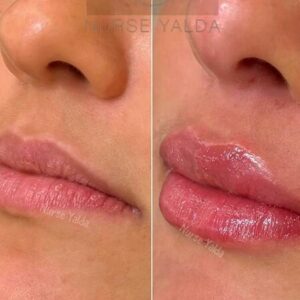 Lip Filler- Rejuvenation Clinic - Vienna Med Spa