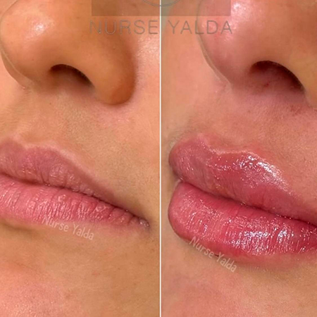 Lip Filler- Rejuvenation Clinic - Vienna Med Spa