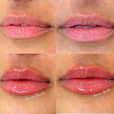 Lip Filler- Rejuvenation Clinic - Vienna Med Spa