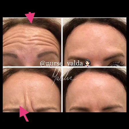 Botox Before and After - Rejuvenation Clinic - Vienna Med Spa