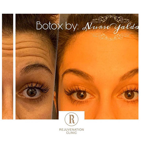 Botox Before and After - Rejuvenation Clinic - Vienna Med Spa