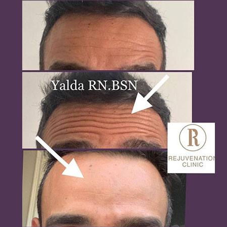 Botox For Man - Before and After - Rejuvenation Clinic - Vienna Med Spa