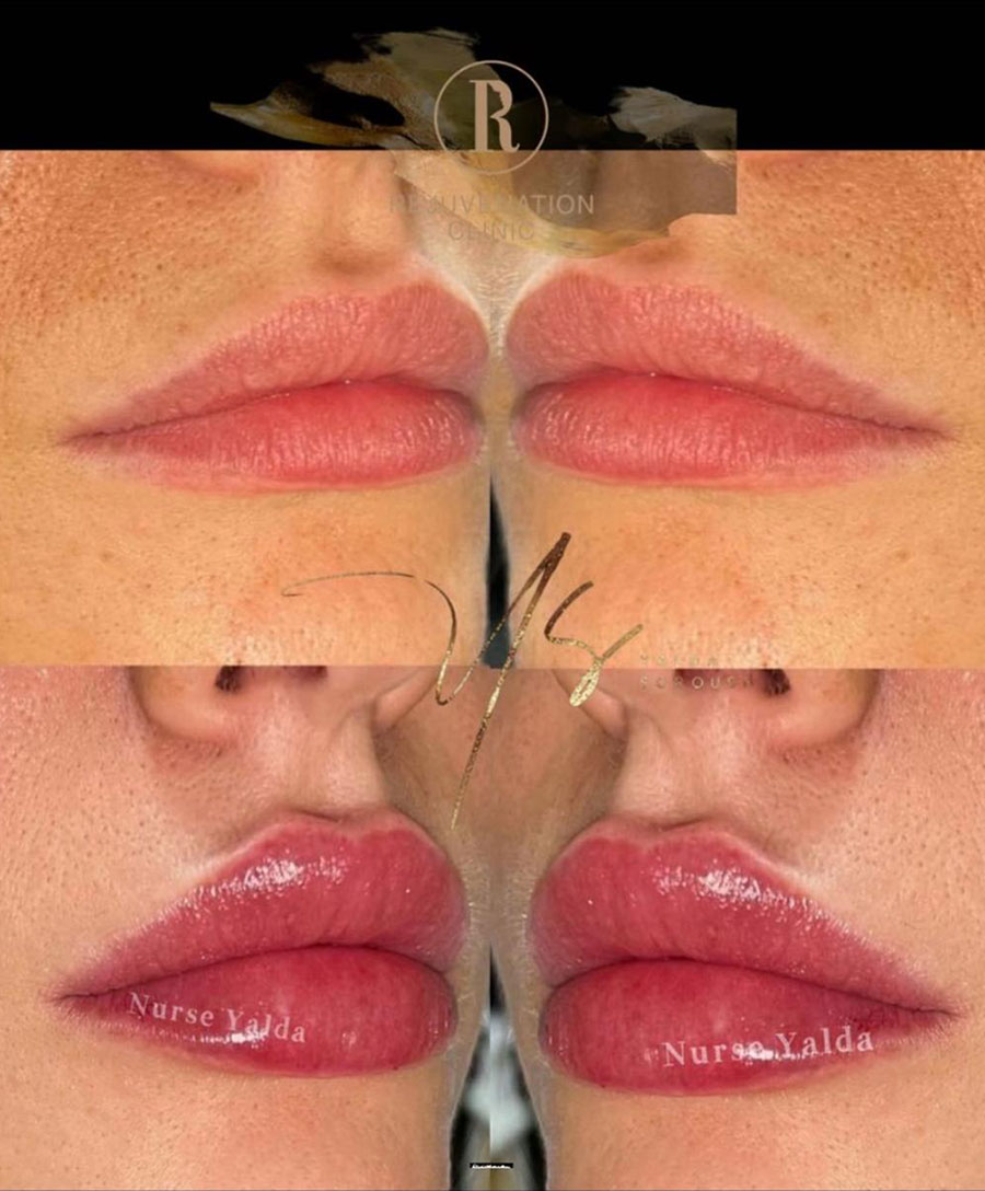 Lip Filler - Rejuvenation Clinic - Vienna Med Spa